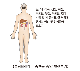 본히펠린다우 증후군